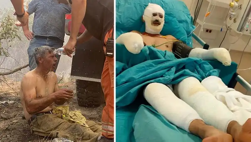 Ormanda Yanıklara Maruz Kalan İşyeri Çalışanının Durumu Ciddi
