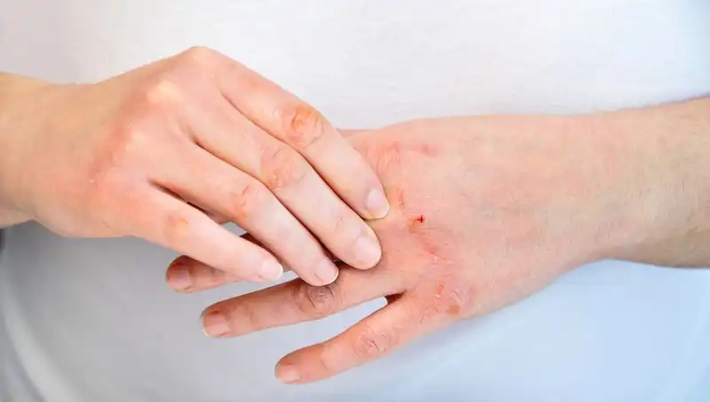 Yetersiz Protein Tüketiminin Belirtileri: 6 Dikkat Çeken İşaret