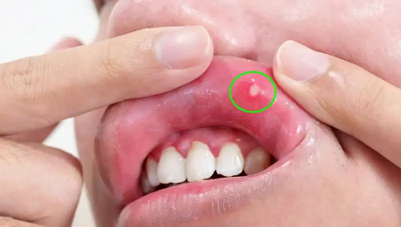 Vücudunuzdaki B Vitamini Eksikliğini Gösteren 5 Uyarı İşareti